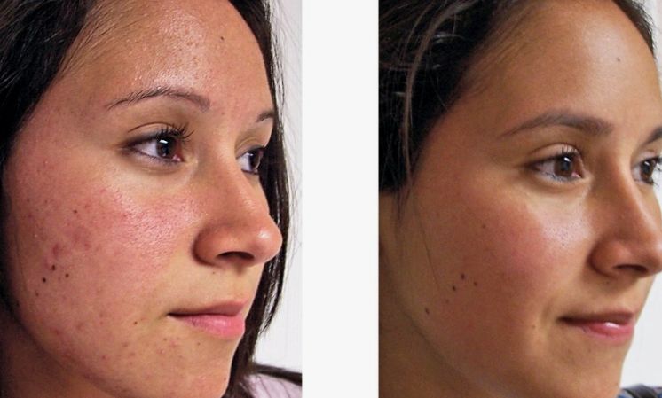Before &After
